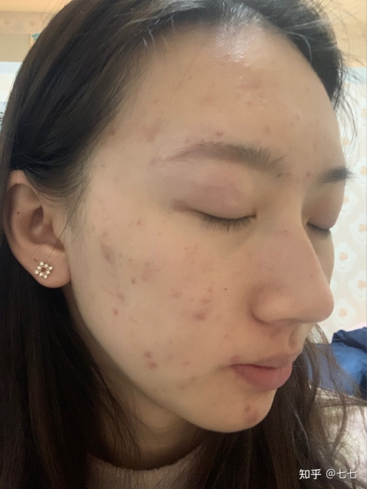 痘印祛痘印痘坑_石家莊祛痘坑痘印大約需要多少錢_祛痘坑痘印的方法有哪些