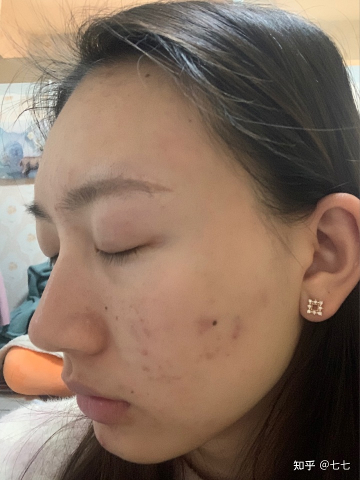 痘印祛痘印痘坑_祛痘坑痘印的方法有哪些_石家莊祛痘坑痘印大約需要多少錢