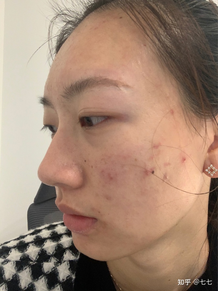 石家莊祛痘坑痘印大約需要多少錢_祛痘坑痘印的方法有哪些_痘印祛痘印痘坑