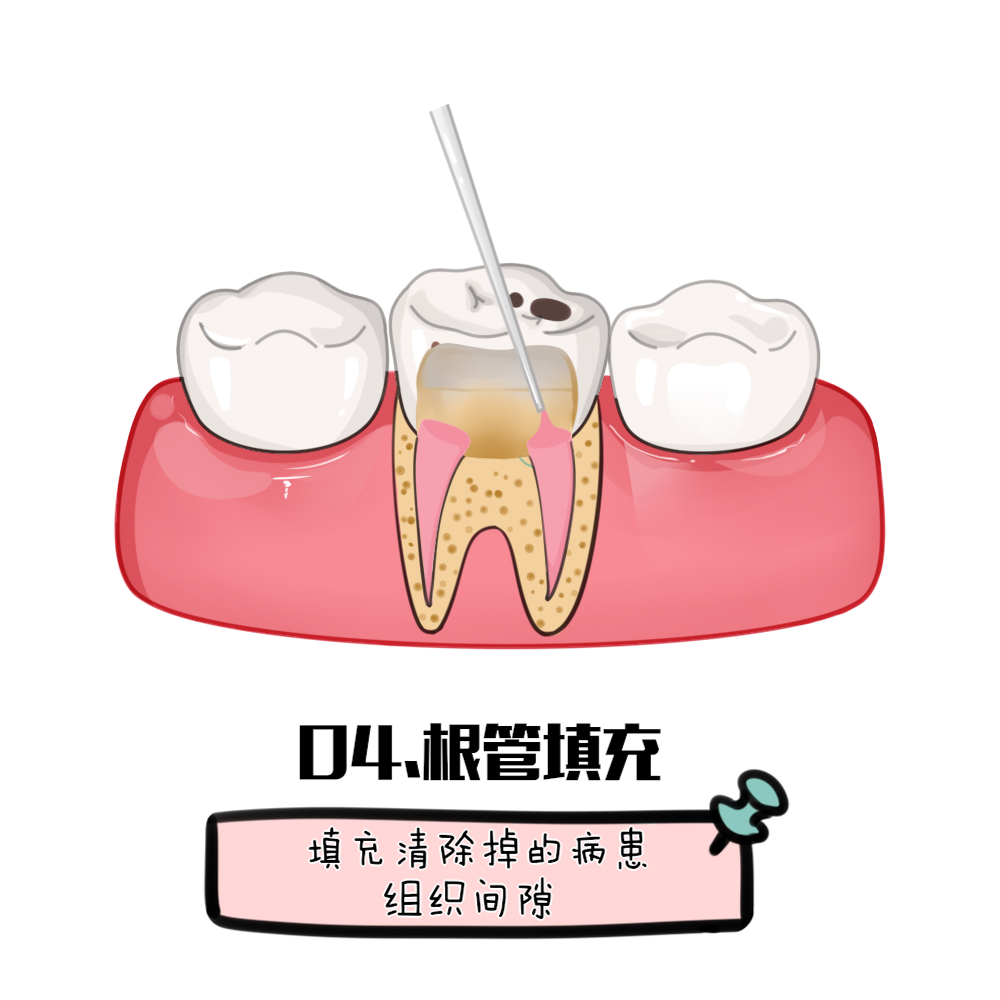 治療蛀牙疼偏方_消滅蛀木蟲的最好方法_蛀牙根管治療方法