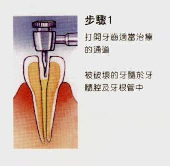 治療蛀牙疼偏方_消滅蛀木蟲的最好方法_蛀牙根管治療方法